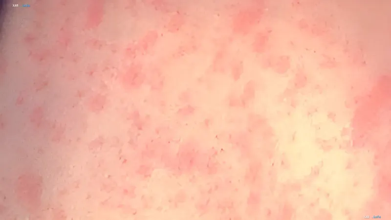 Close-up of a red skin rash on the body representing measles symptoms during the US outbreak