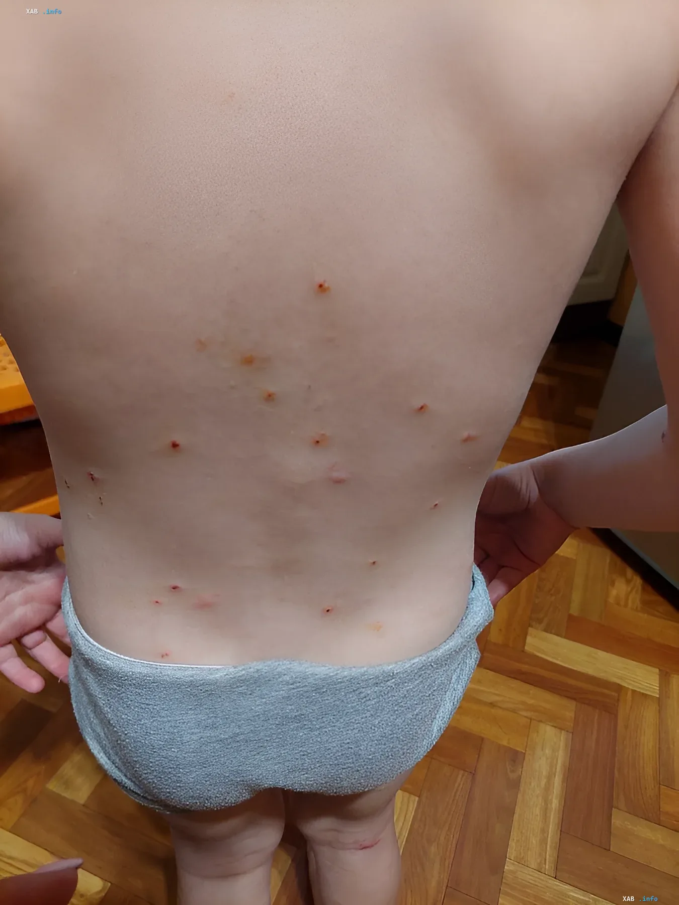 Укусы насекомых на спине ребенка, последствия нашествия блох в Николаеве