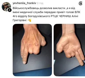 Фотография руки военнослужащего с ампутацией пальцев, иллюстрирующая спорные случаи годности к службе по приказу № 262